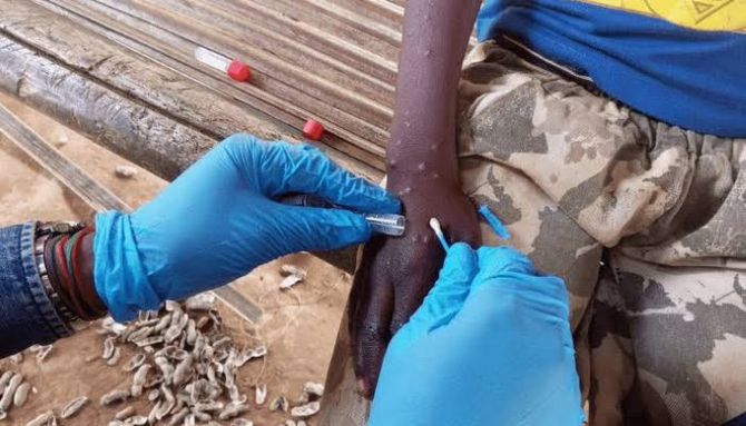 Mpox Case Reported in Trans Nzoia County